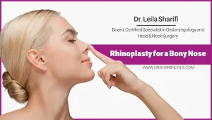 Bony Nose Rhinoplasty