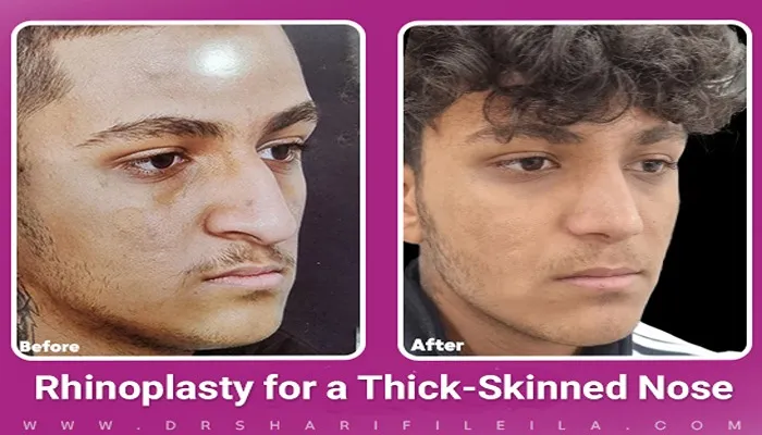 Fleshy Nose Rhinoplasty