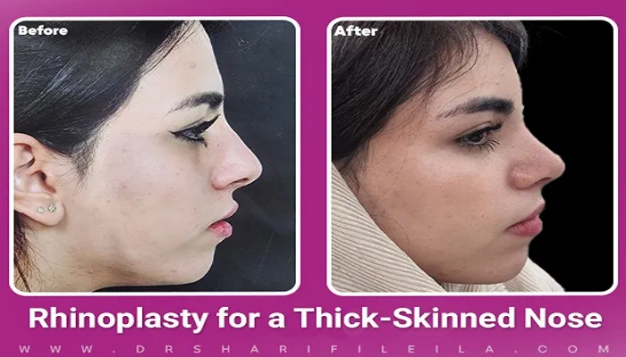 Fleshy Nose Rhinoplasty