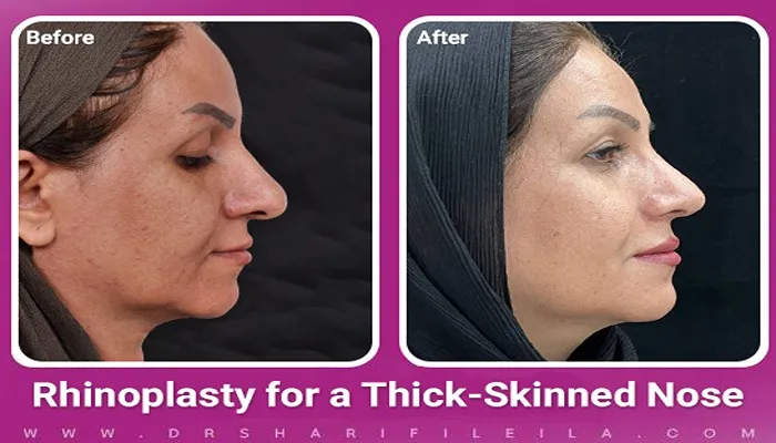 Fleshy Nose Rhinoplasty