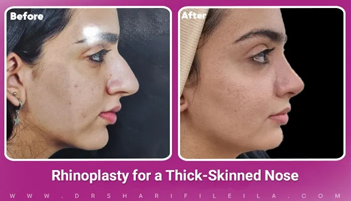 Fleshy Nose Rhinoplasty