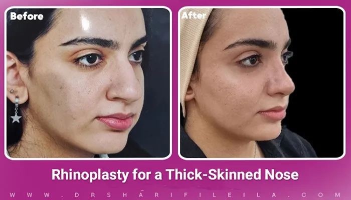 Fleshy Nose Rhinoplasty