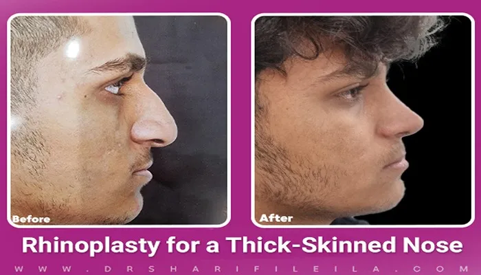Fleshy Nose Rhinoplasty