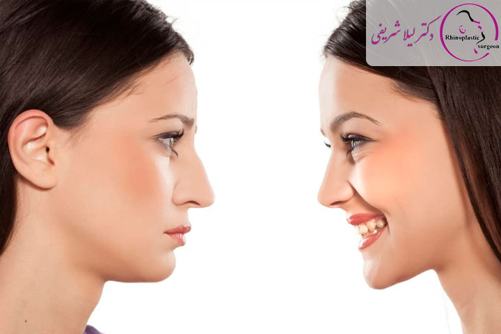 کاهش عوارض خنده بعد از عمل بینی