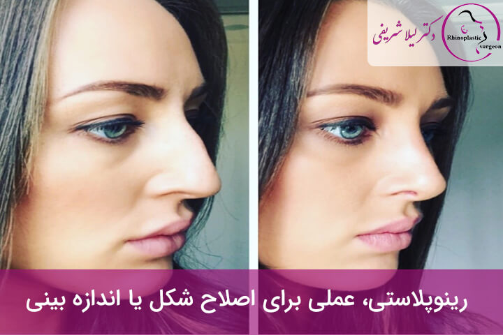 رینوپلاستی