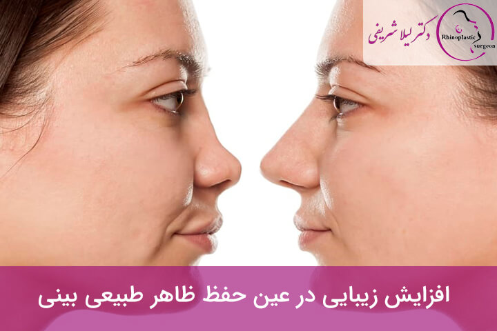 افزایش زیبایی در عین حفظ ظاهر طبیعی بینی