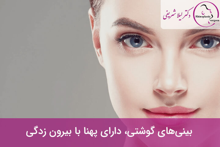 بینیهای گوشتی