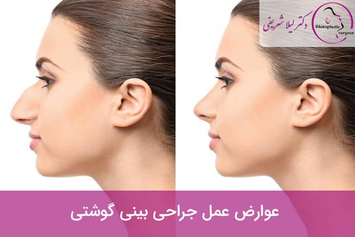 عوارض عمل جراحی بینی گوشتی