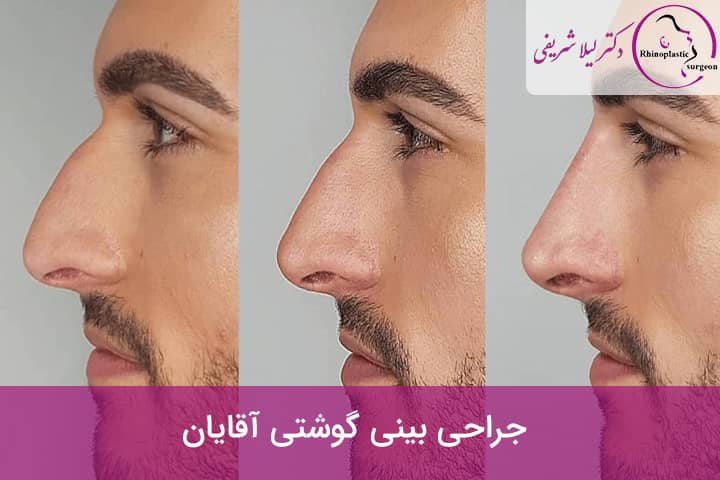 جراحی بینی گوشتی آقایان