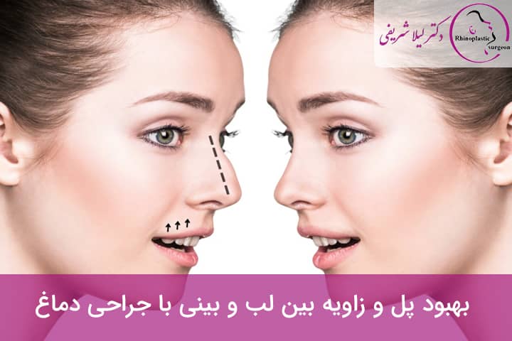 بهبود پل و زاویه بین لب و بینی با جراحی بینی