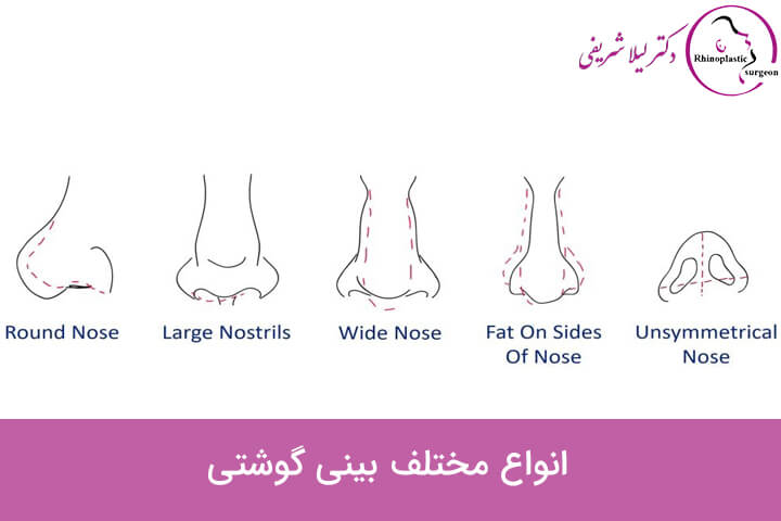 انواع مختلف بینی گوشتی