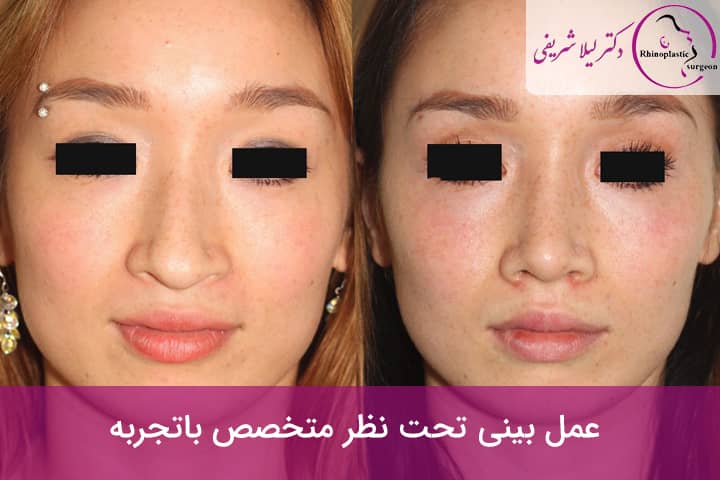 عمل بینی تحت نظر متخصص باتجربه