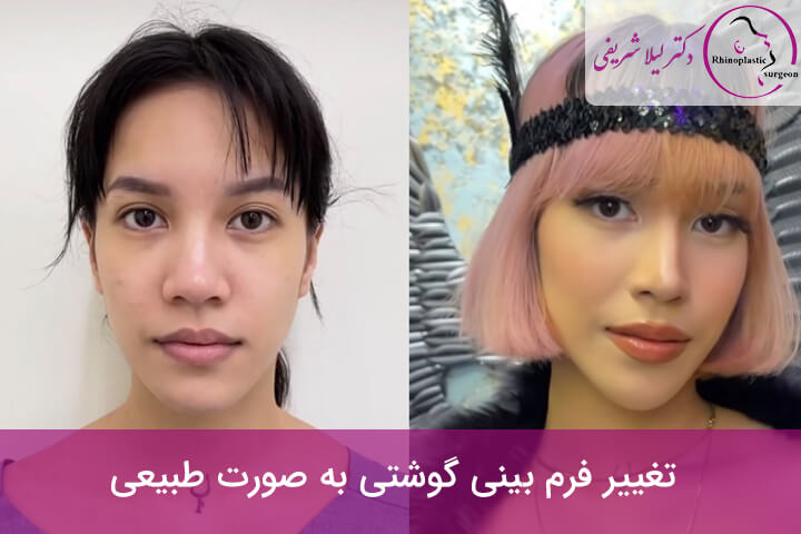 تغییر فرم بینی گوشتی به صورت طبیعی