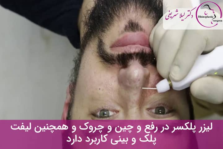 لیفت بینی با پلکسر