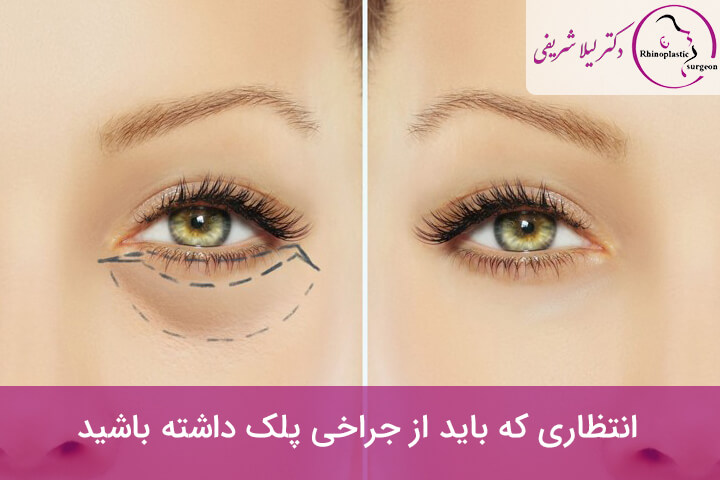 نتایج عمل بلفاروپلاستی