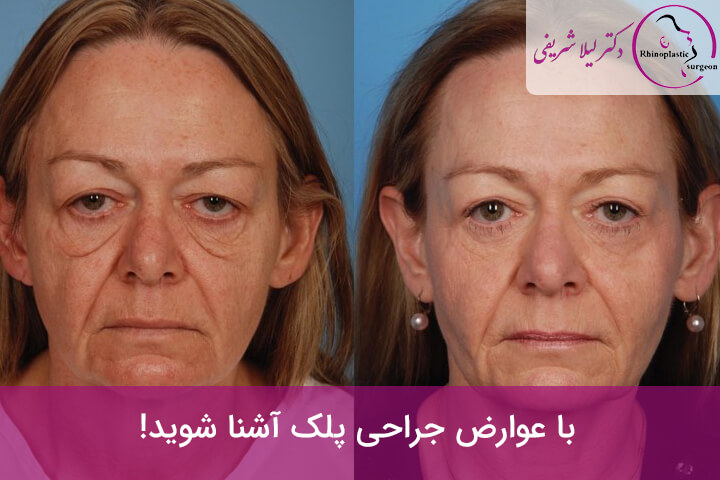 عوارض جراحی پلک
