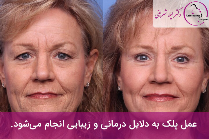 هدف از انجام عمل پلک