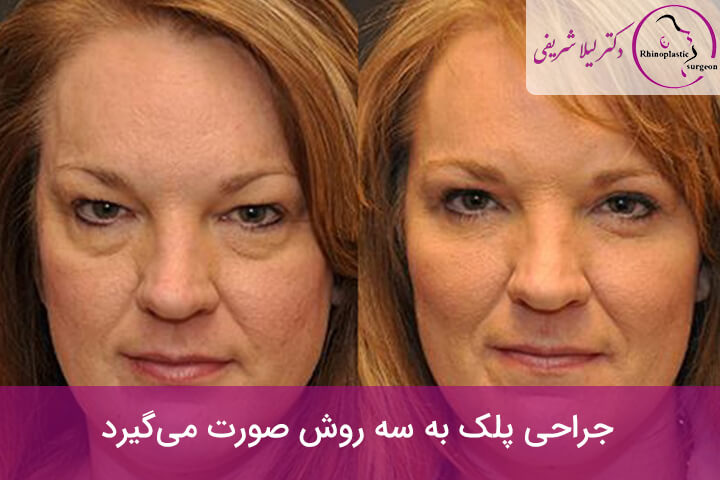 انواع روش جراحی چشم