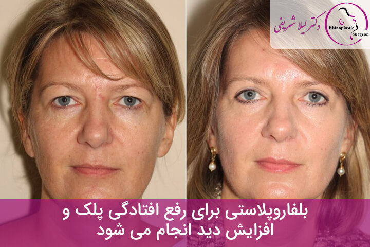 اهداف عمل بلفاروپلاستی