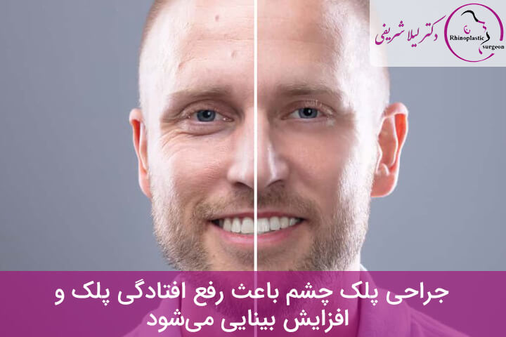 مزایای جراحی پلک