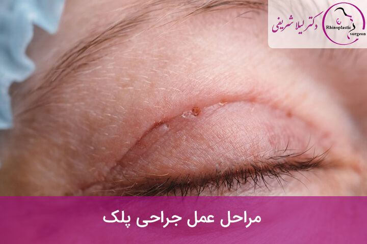 عمل جراحی پلک