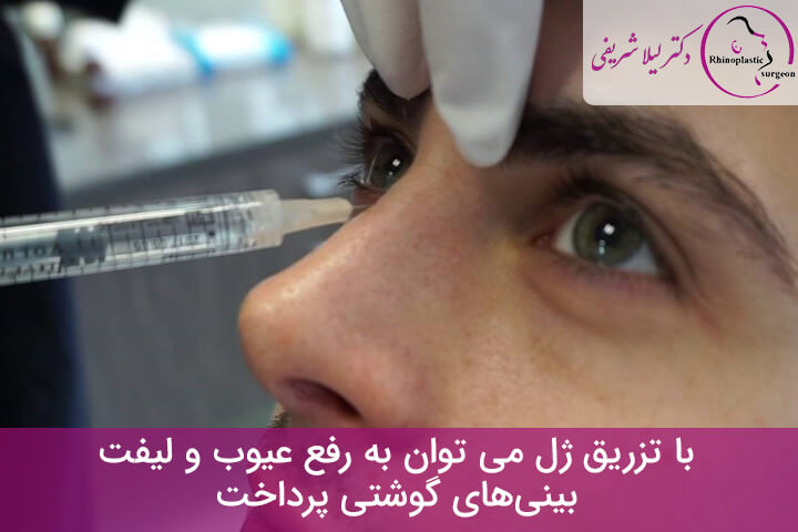 فیلر در لیفت بینی