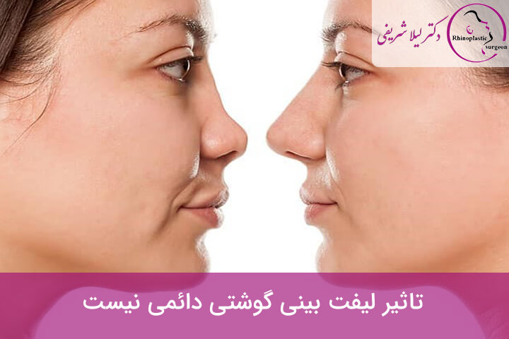 ماندگاری لیفت بینی