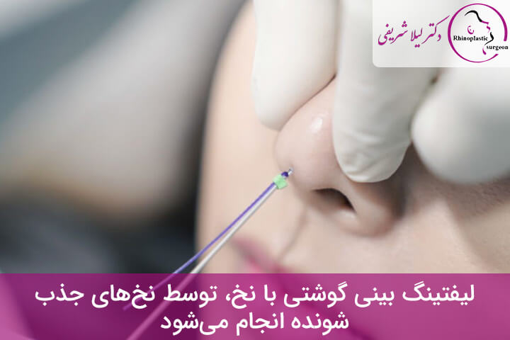 لیفت بینی با نخ