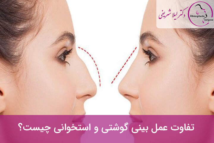 بینی استخوانی یا غضروفی