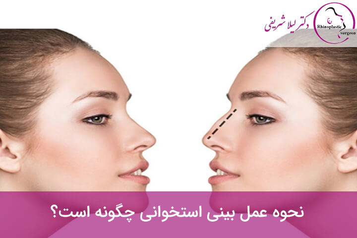 مشخصات بینی استخوانی یا غضروفی