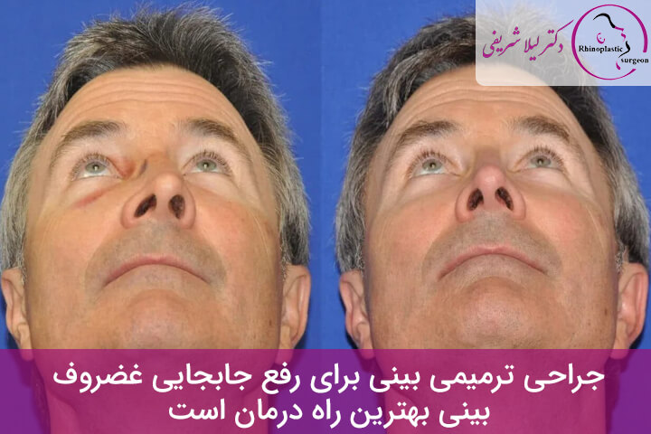 جراحی جابجایی غضروف بینی