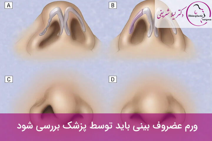 مدت زمان ورم بینی