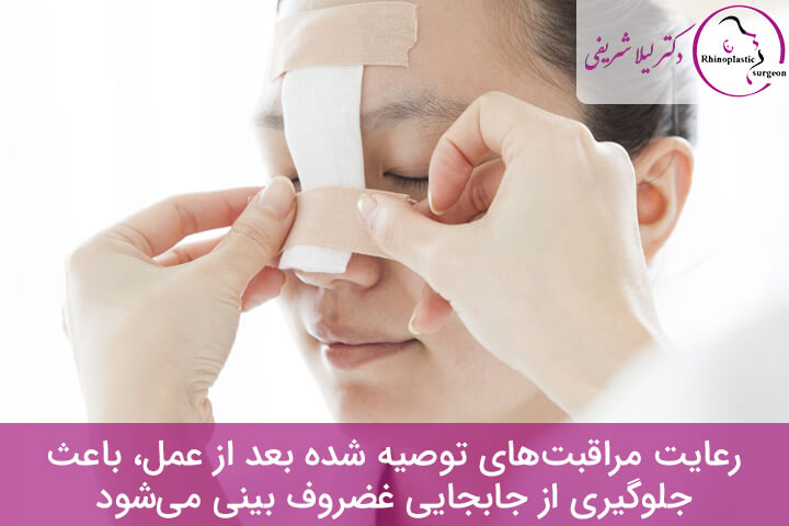 جابجایی غضروف بینی بعد از عمل