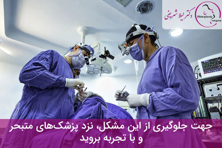 جابجایی غضروف بینی بعد عمل