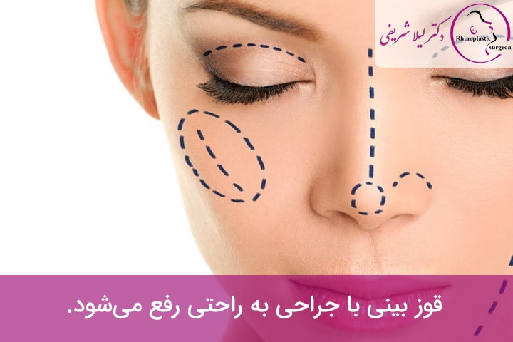عمل بینی قوزدار