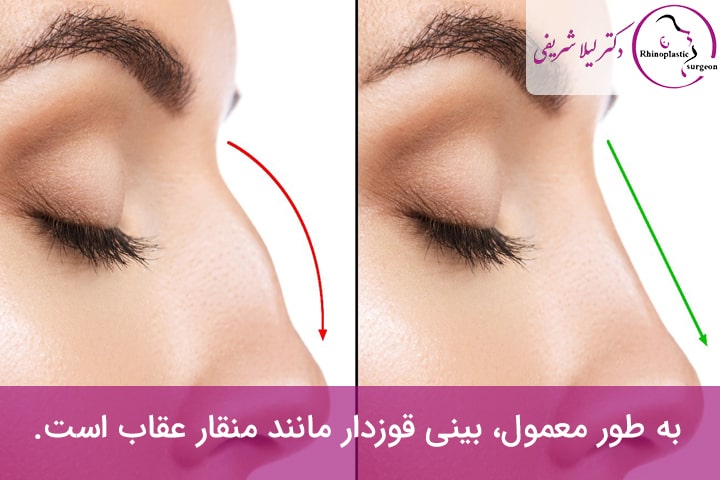 عمل بینی قوز دار