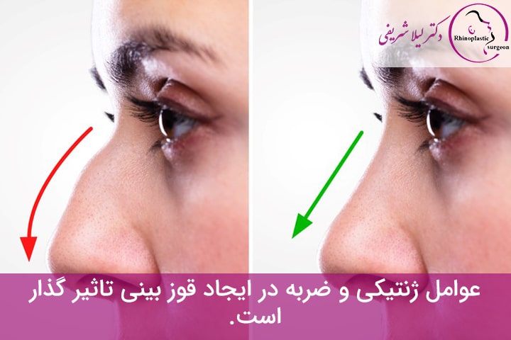 دلیل ایجاد قوز بینی