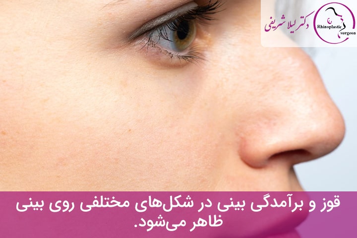انواع قوز بینی
