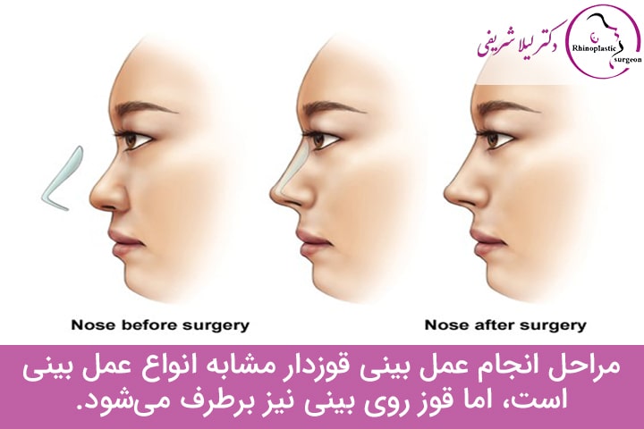 نحوه انجام عمل بینی قوزدار