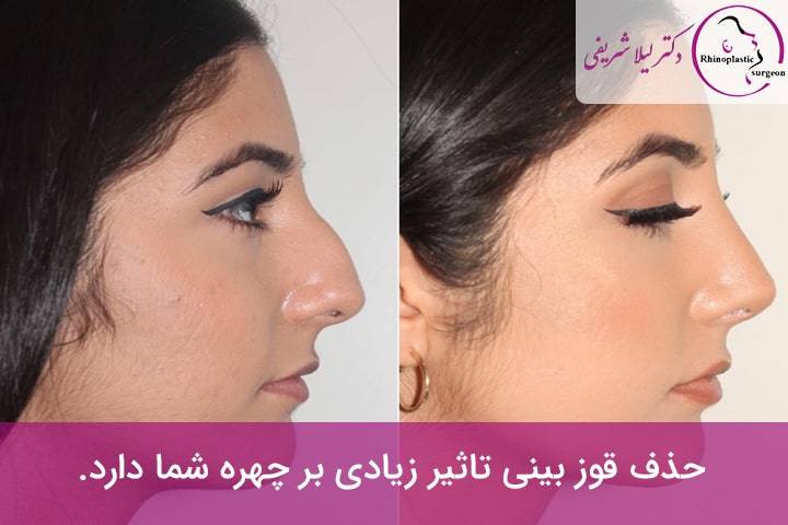 جراحی بینی قوزدار