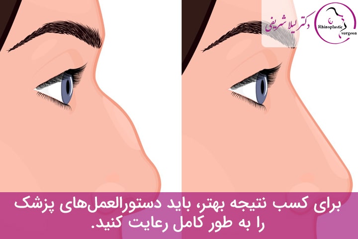 مراقبت های بعد عمل بینی قوزدار