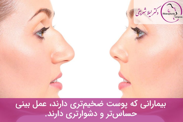 عمل‌ بینی‌ قوز دار