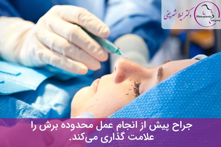 اقدامات قبل از انجام جراحی بینی گوشتی