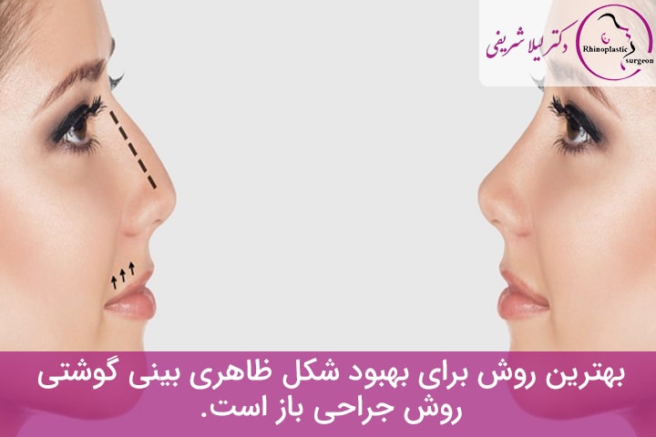 بینی گوشتی