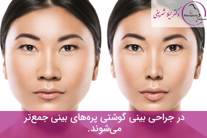 نحوه عمل بینیهای گوشتی و بزرگ