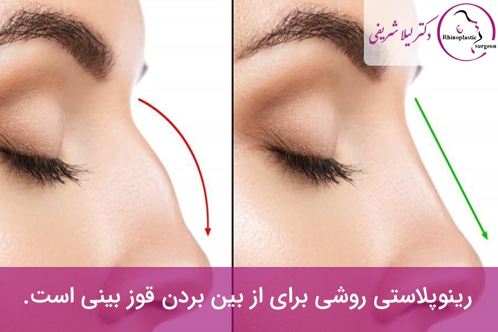 مزایای از بین بردن قوز بینی استخوانی