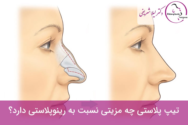فرق تیپ پلاستی و رینوپلاستی