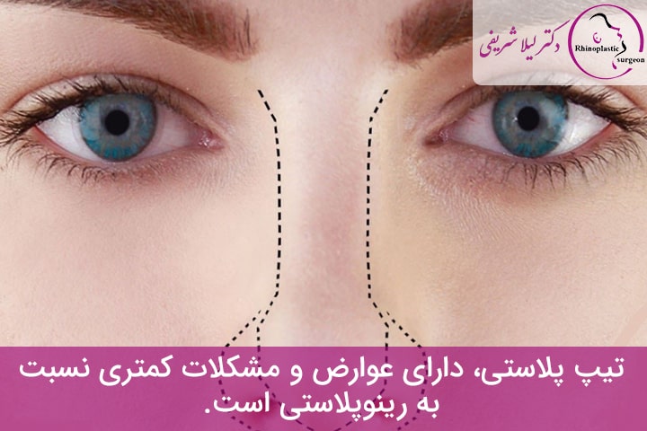 جراحی نوک بینی
