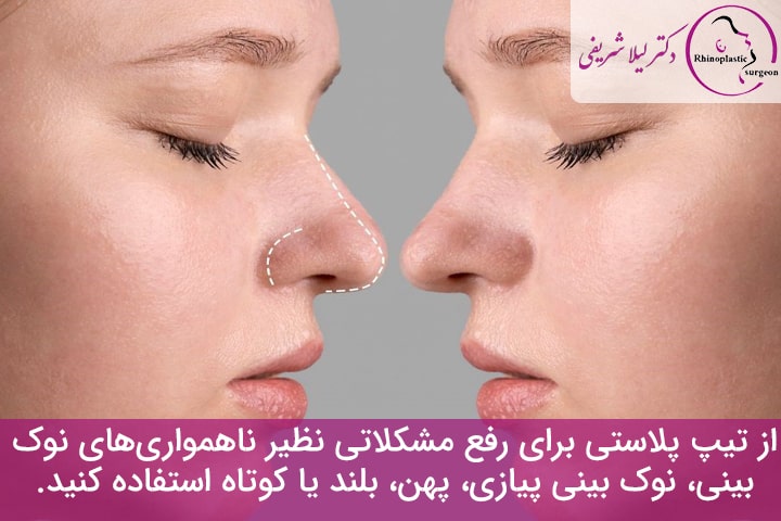 جراحی نوک بینی