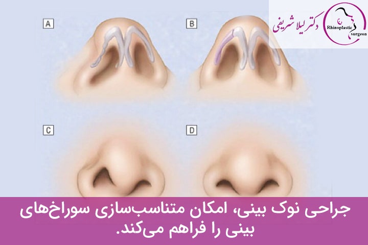 اصلاح عدم تقارن سوراخ‌های بینی